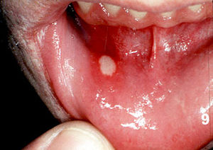 White Lesion In Mouth 44